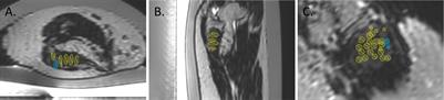 Case Report: Desmoid tumor response to magnetic resonance-guided high intensity focused ultrasound over 4 years